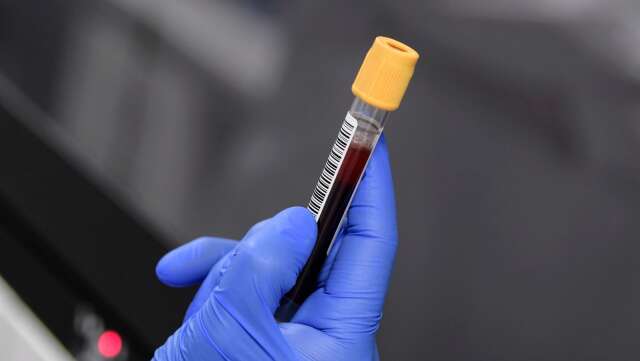 Ett blodprov kan avslöja hur allvarlig en skallskada är, enligt ny forskning på Örebro universitet.