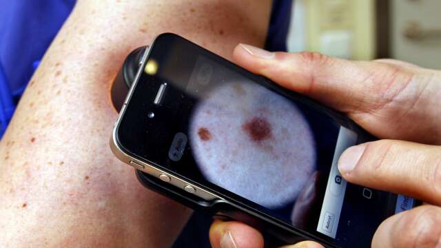 Antalet fall av malignt melanom ökar över hela landet. Bilden föreställer hur det kan se ut när man undersöker en hudförändring hos en hudläkare. 