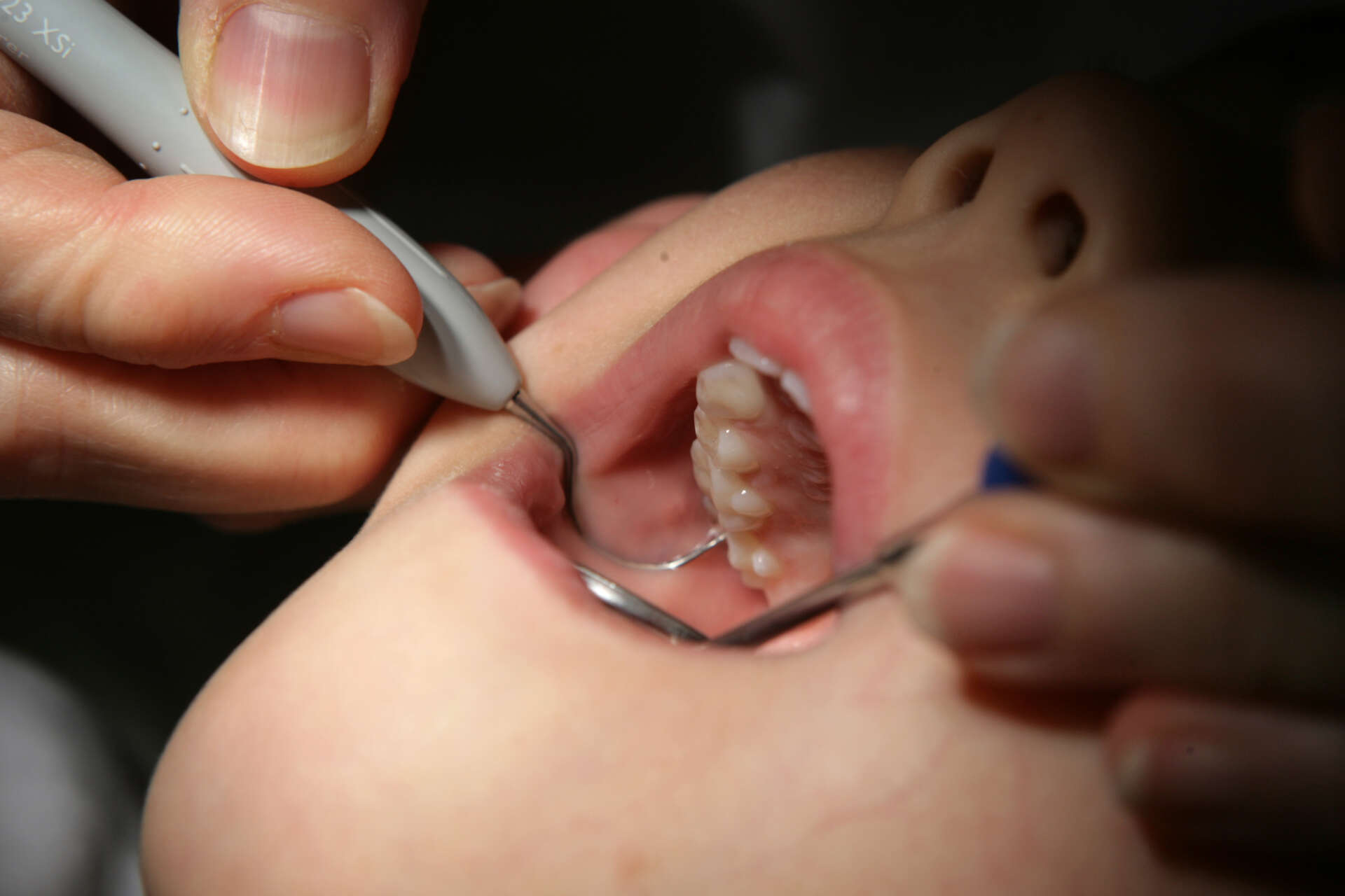 En liten flicka får tänderna undersökta hos tandläkaren. Arkivbild.
