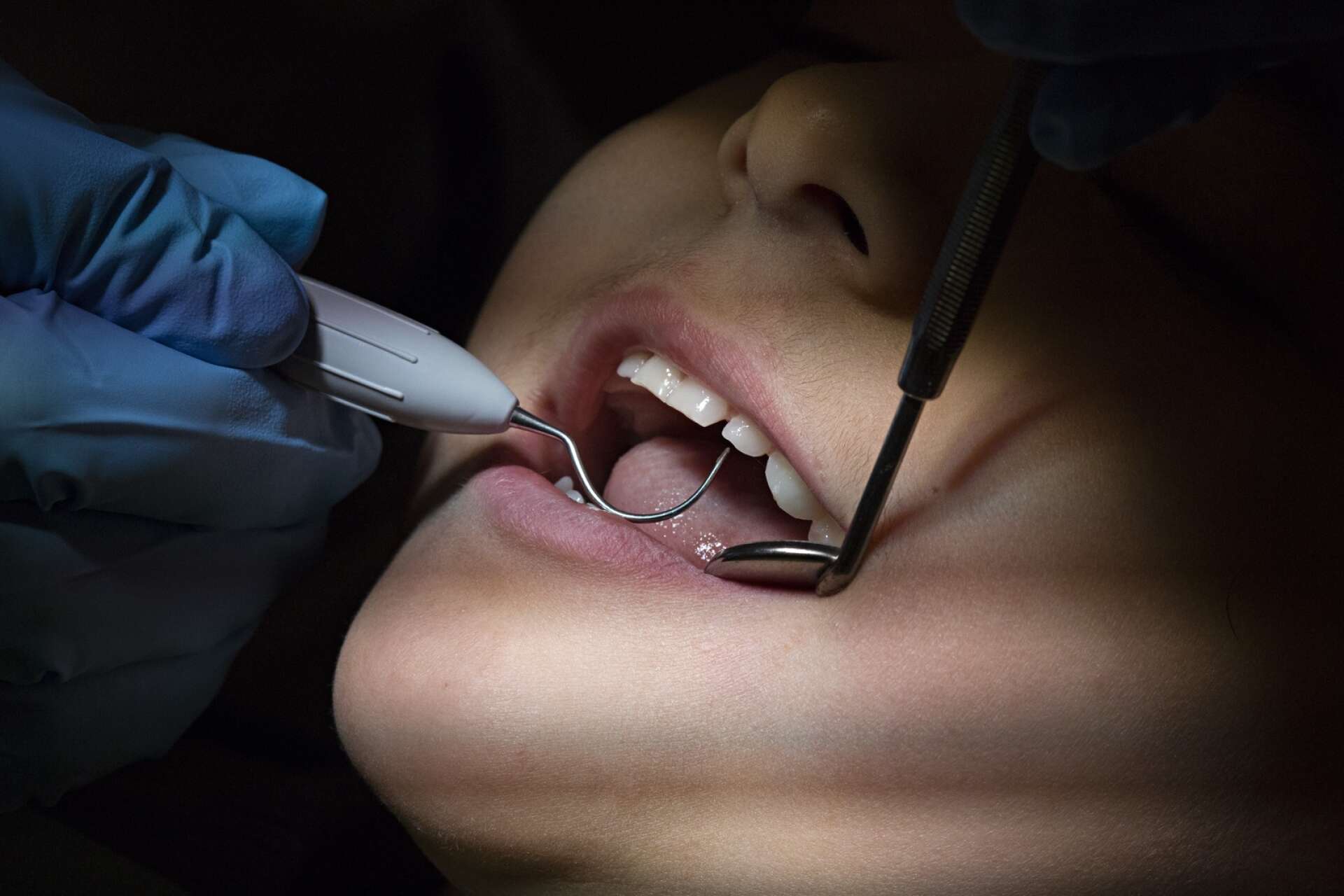 Värmländska barns tandhälsa har gått från bäst till sämst i landet – åtminstone vad gäller den tredjedel som har mest problem med sina tänder.