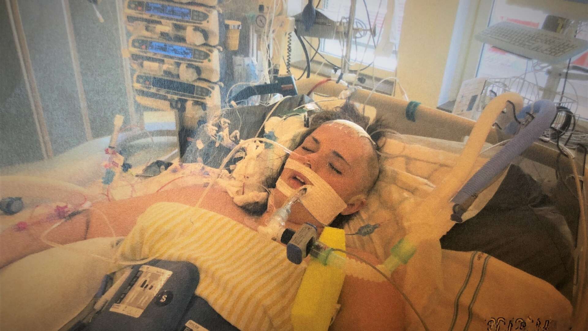 Emmy låg i respirator de första dygnen efter olyckan.