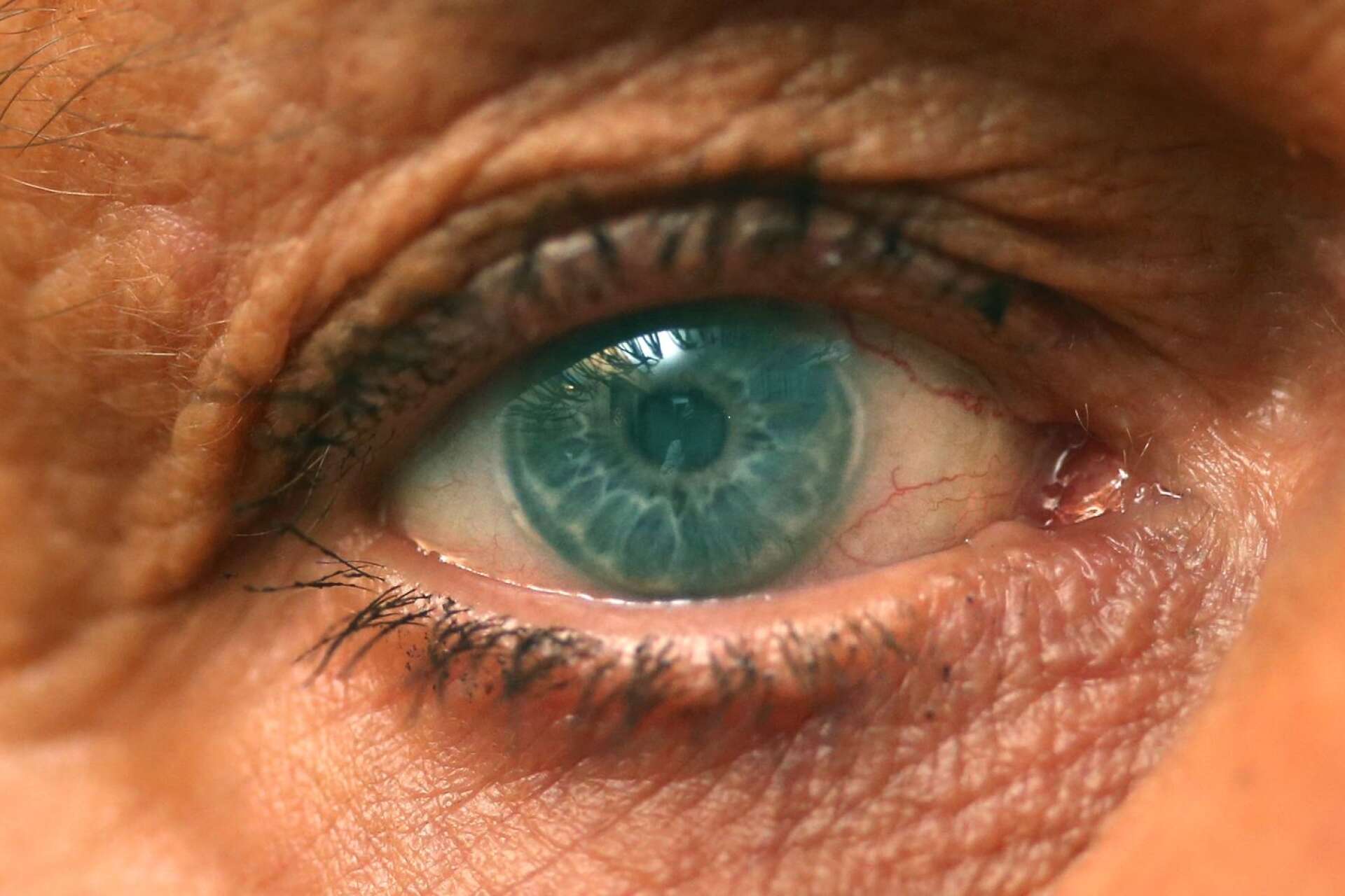 &quot;Nu är det bara en grå sörja&quot;, säger 70-åriga Christina Klasson i Karlstad om hur illa hon ser med sitt högra öga.